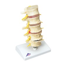 3B Scientific Anatomical Model - vertebrae degeneration, stages of prolapsed disc - Includes 3B Smart Anatomy