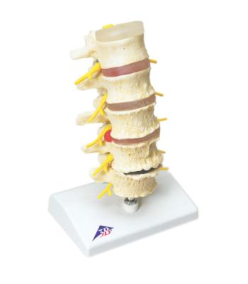 3B Scientific Anatomical Model - vertebrae degeneration, stages of prolapsed disc - Includes 3B Smart Anatomy