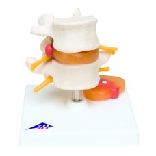 3B Scientific Anatomical Model - Lumbar Spinal Column with Prolapsed Intervertebral Disc - Includes 3B Smart Anatomy