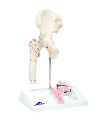 3B Scientific Anatomical Model - Femoral Fracture and Hip Osteoarthritis - Includes 3B Smart Anatomy