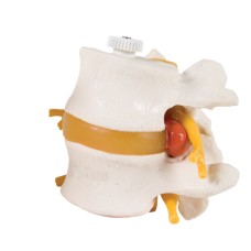 3B Scientific Anatomical Model - 2 Lumbar Vertebrae with prolapsed disc, flexibly mounted - Includes 3B Smart Anatomy