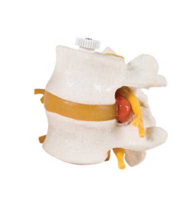 3B Scientific Anatomical Model - 2 Lumbar Vertebrae with prolapsed disc, flexibly mounted - Includes 3B Smart Anatomy