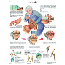 Anatomical Chart - arthritis, paper