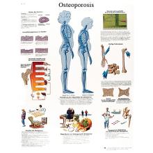 Anatomical Chart - osteoporosis, paper