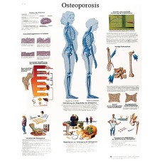 Anatomical Chart - osteoporosis, laminated