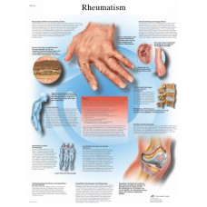 Anatomical Chart - rheumatic diseases, paper