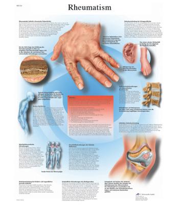 Anatomical Chart - rheumatic diseases, laminated
