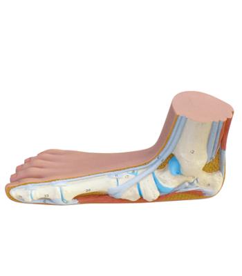 3B Scientific Anatomical Model - Flat Foot (Pes Planus) - Includes 3B Smart Anatomy