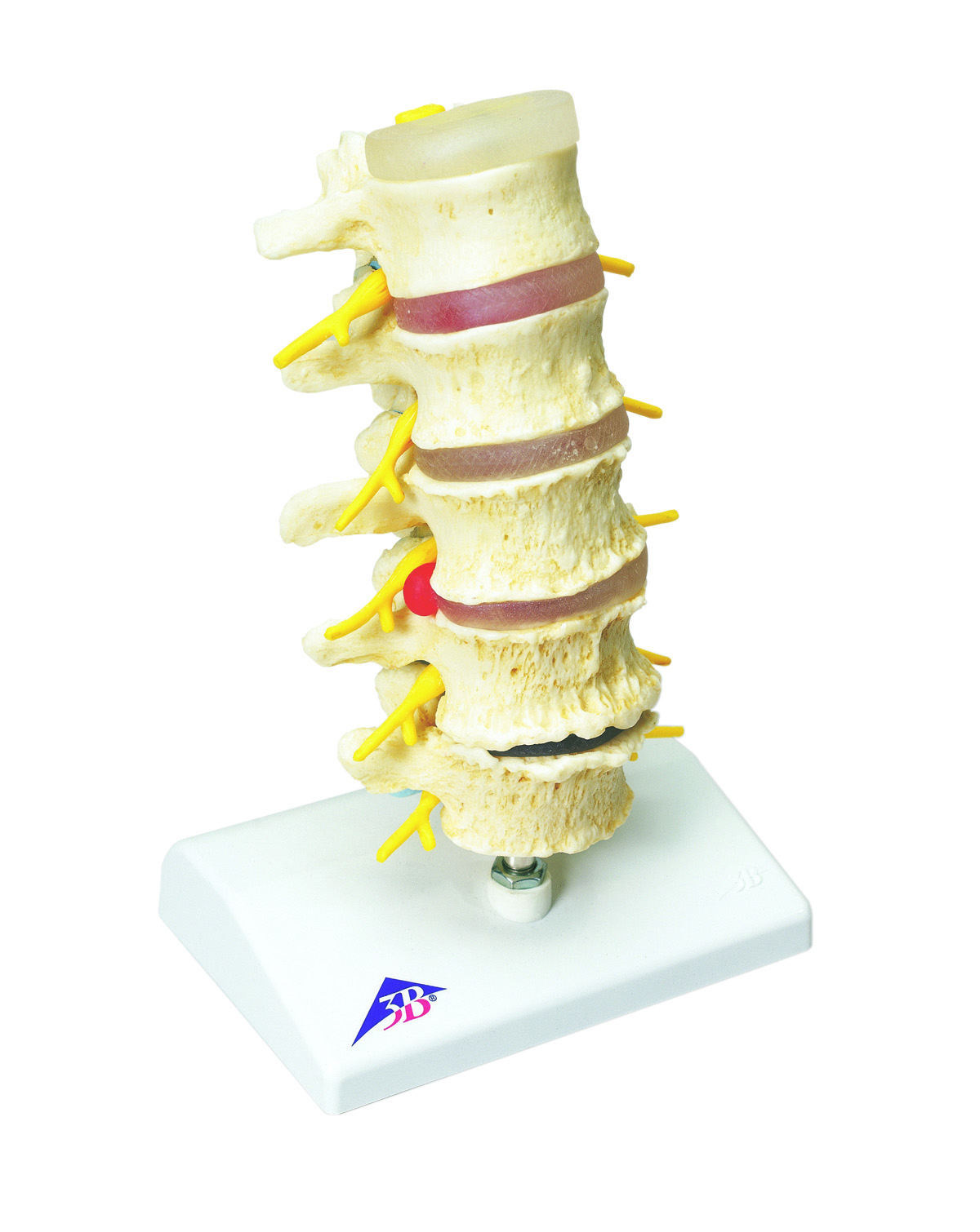3B Scientific Anatomical Model - vertebrae degeneration stages of prolapsed disc - Includes 3B Smart Anatomy
