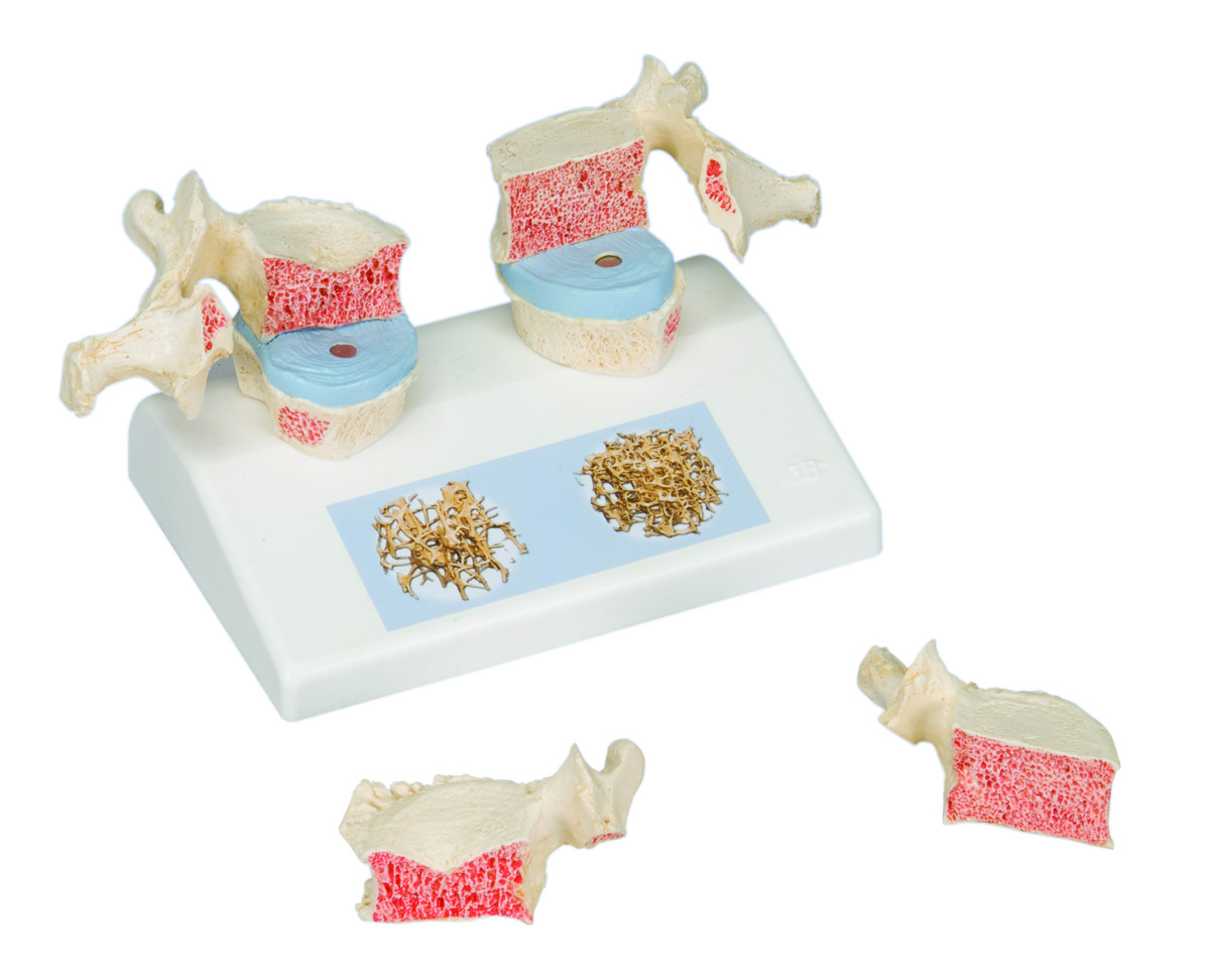 3B Scientific Anatomical Model - osteoporosis model - Includes 3B Smart Anatomy