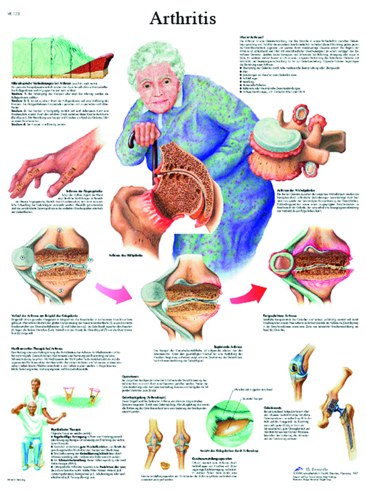 Anatomical Chart - arthritis laminated