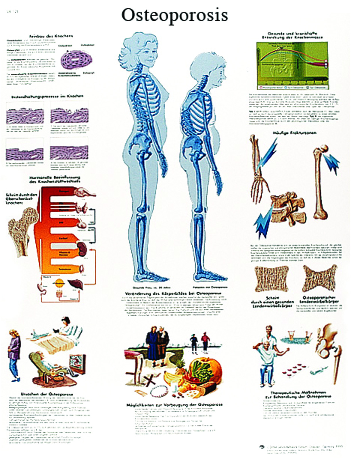 Anatomical Chart - osteoporosis laminated